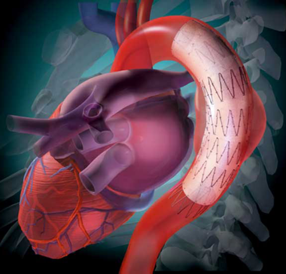 Endovascular Graft for treatment of a thoracic aortic aneurysm Linda Nye Visualizing Nature