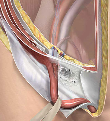 Surgical Technique guide for repair of a direct Inguinal Hernia. Linda Nye Visualizing Nature