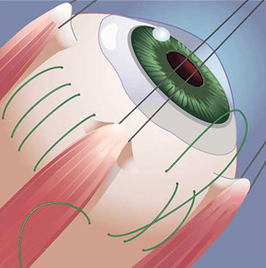 Series for ophthalmic surgery suture brochure Linda Nye Visualizing Nature