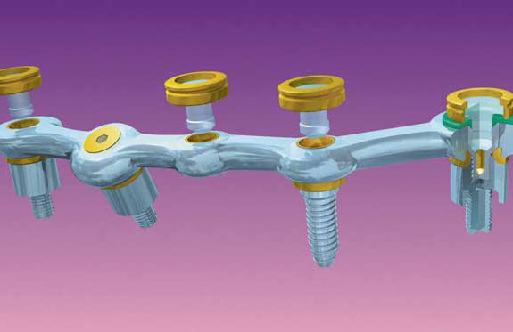 Model of Dental Implant 